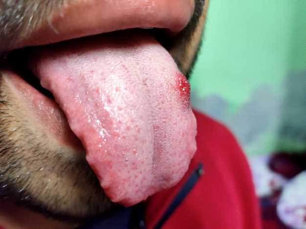 Azithromycin and black tongue