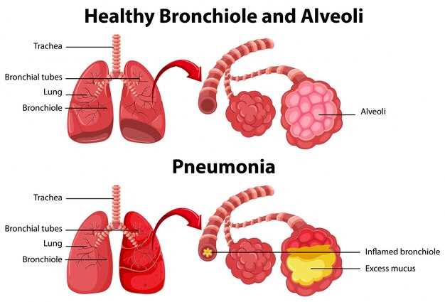 Azithromycin for klebsiella pneumoniae