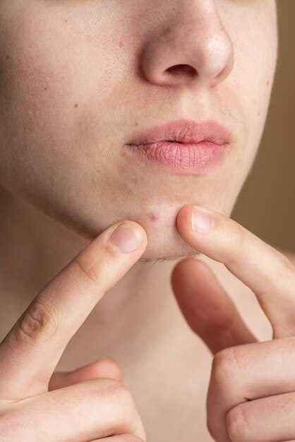 Doxycycline acne yeast infection