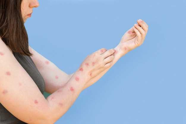 Doxycycline causes rash