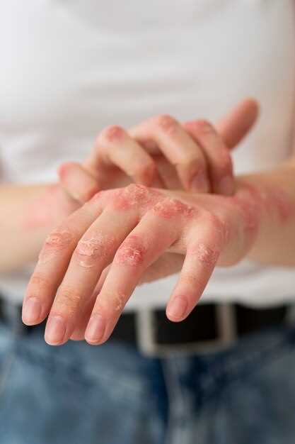 Doxycycline seborrheic dermatitis