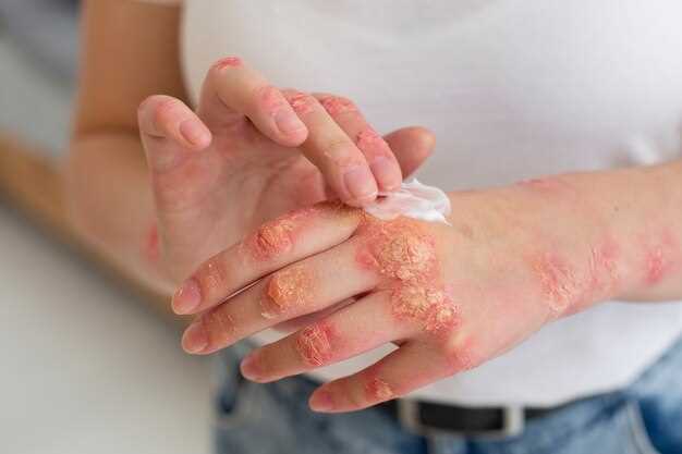 Doxycycline side effects rash