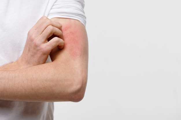 Duloxetine side effects rash