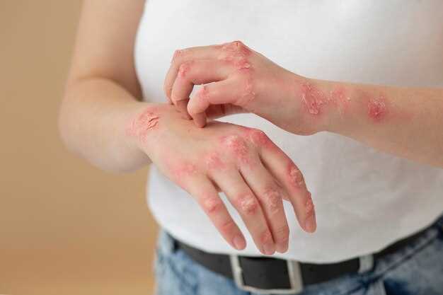 Skin rash caused by azithromycin